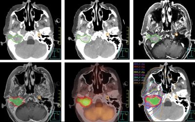 La inmunoterapia se integra de forma muy rápida en los protocolos de investigación de cáncer de cabeza y cuello